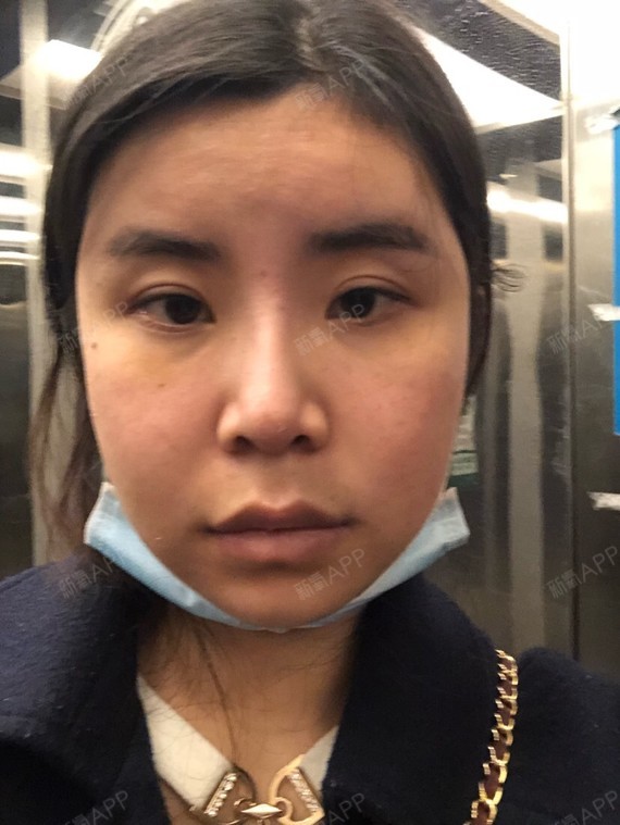 我的眼角一直很上吊,但是我给人的感觉不会很凶的感觉_圈子-新氧美容