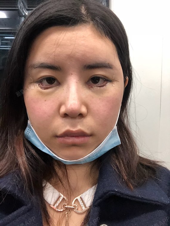 我的眼角一直很上吊,但是我给人的感觉不会很凶的感觉_圈子-新氧美容