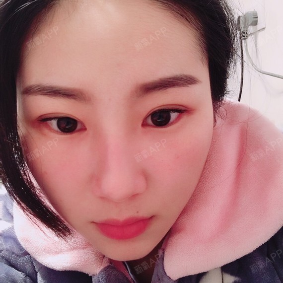温州开内眼角好不好_效果图_严大发开内眼角术后第135天_新氧美容整形