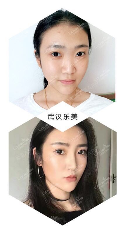 鼻部多项对比,鼻头之前没有型不立体,抬高鼻梁鼻小柱延长后