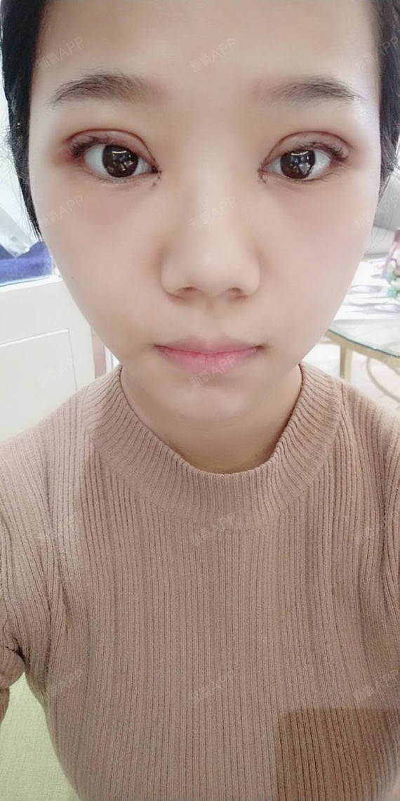 新氧- 氧气7358651520823742 | 眼部 | 开眼角 | 双眼皮 | 开外眼角