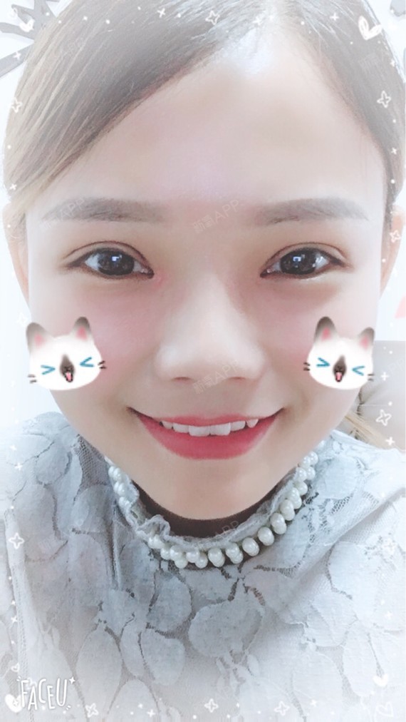 术后十天啦,本来想着双眼皮是个很大工程,需要好几个_圈子-新氧美容