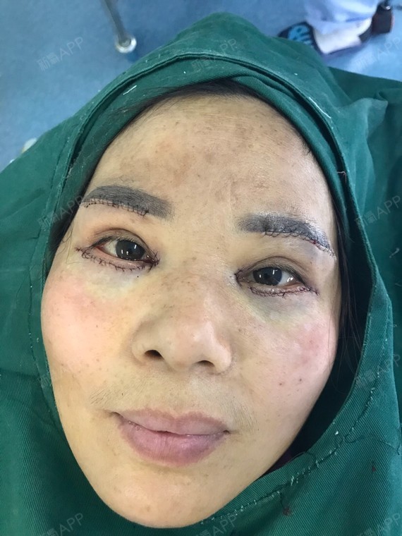 提眉开眼角去眼袋_圈子-新氧美容整形