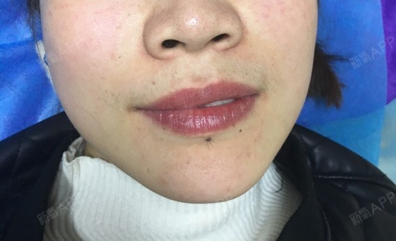激光脱毛