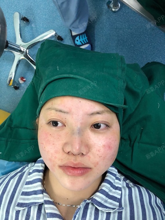 鼻部多项做完自然效果看得见_圈子-新氧美容整形