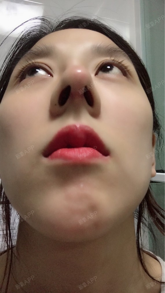 肋软骨鼻部多项2个多月了,鼻孔还是那么尖,以后能变成椭圆形吗,还会