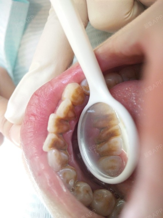 吃个人冷静一下撒超声波洗牙第1天美丽日记