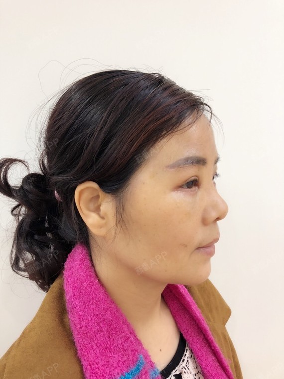 武汉明亮医美去眼袋开眼角提眉术后6天