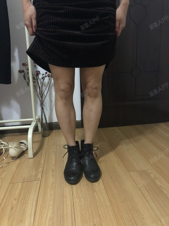 新氧- 绮绮雨 | 瘦脸 | 肉毒素瘦小腿 | 术后当自强 | 昆明同城