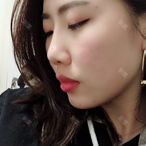 上海百達麗醫療美容耳軟骨複合隆鼻怎麼樣_恢復過程_效果如何_咪了個