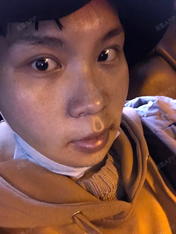 咕噜帮你来看脸颧骨颧弓整形术第8天美丽日记