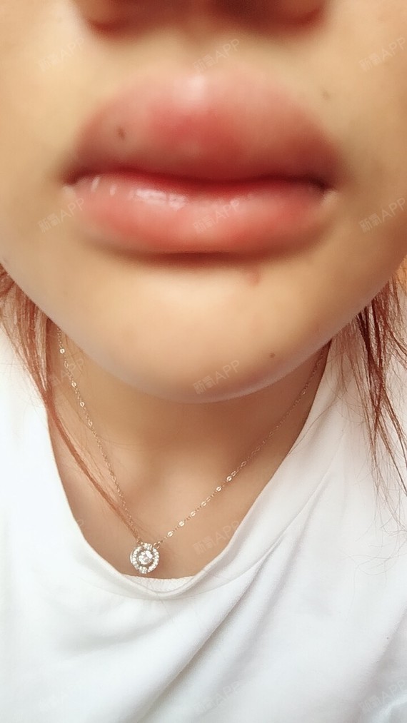 注射第二天上唇肿的像香肠一样一样  而且没有型 怎么办 多久可以消