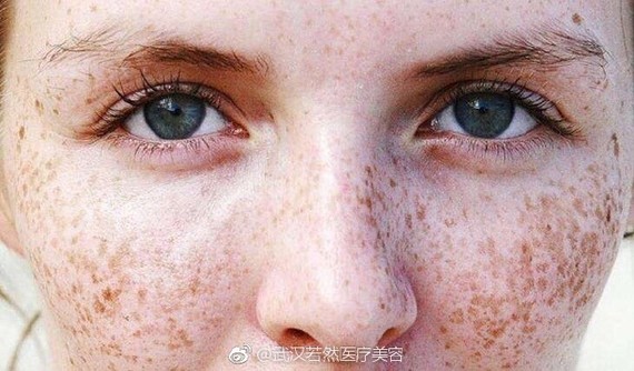 若然小知识:斑痕是如何产生的?