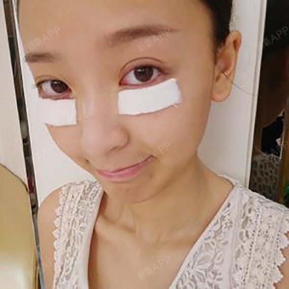 眼部多项好不好_效果图_我不可爱眼部多项术后第0天_新氧美容整形