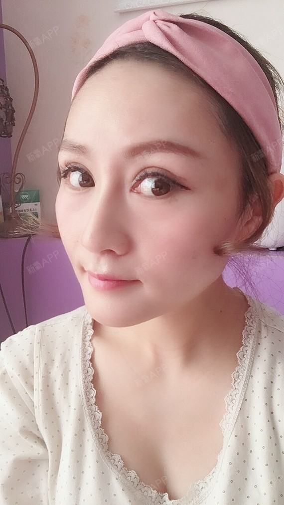 时间过的真快啊,不知不觉的做完线雕加玻尿酸隆鼻一百_圈子-新氧美容