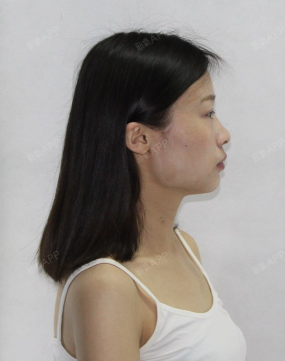 所谓不完美的脸型,我算是一个典型吧!颧骨突出,下颌角肥大!