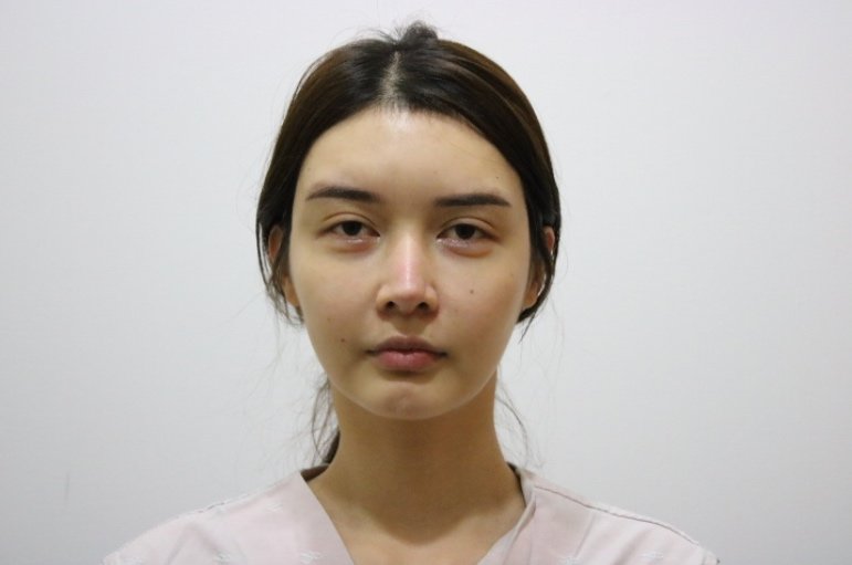 韩国女神整形外科颧骨内推怎么样_恢复过程_效果如何_风一样的孩纸儿