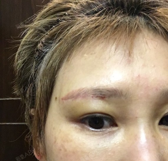 新氧- queensophie | 眼部 | 术后当自强 | 切眉术 | 上眼睑 | 上海