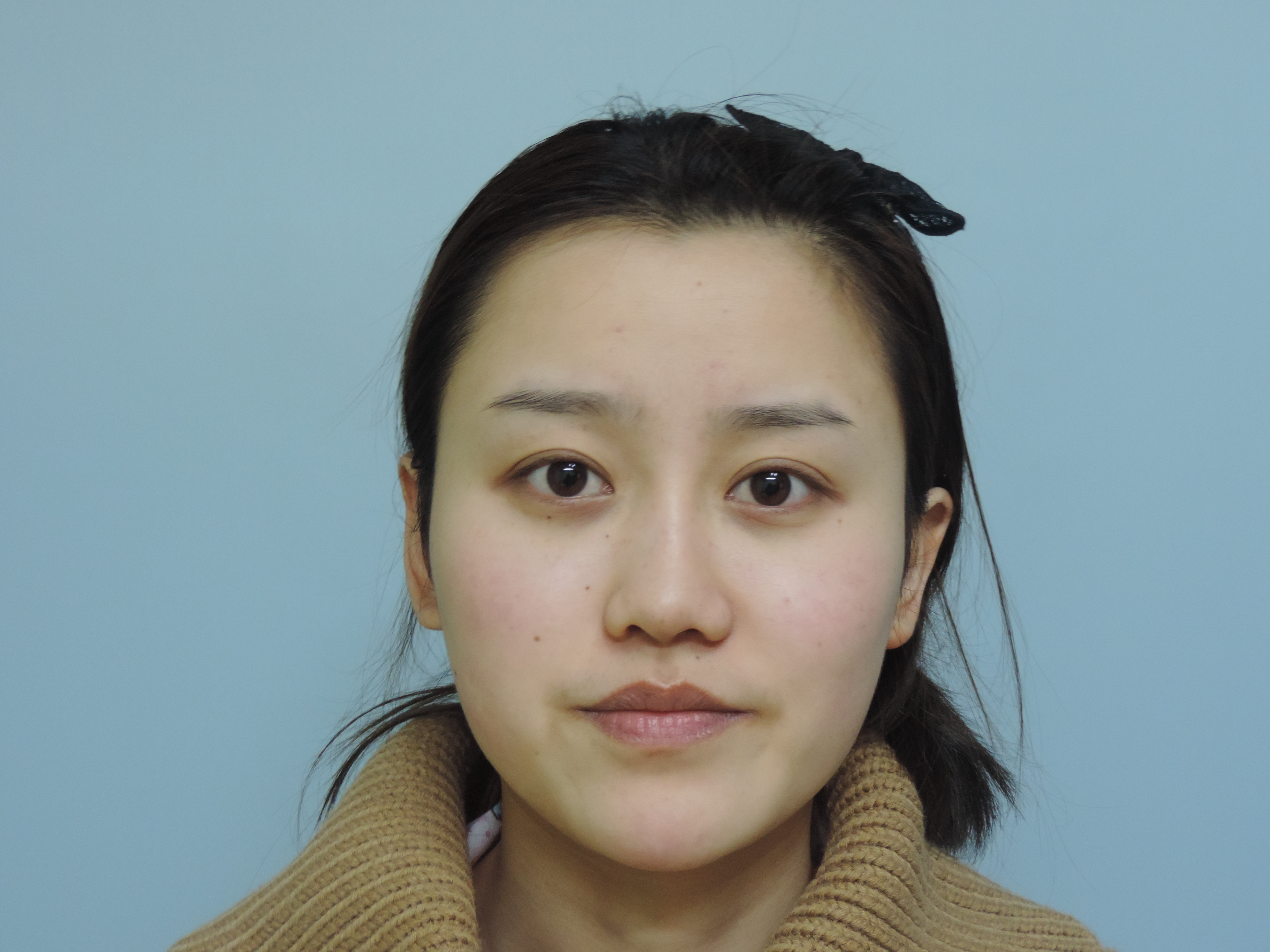 硅胶隆鼻怎么样_恢复过程_效果如何_青岛妇婴医院整形日记4.