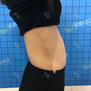 腹部好不好_效果图_非吴下阿萌射频溶脂瘦腹部术后第天_新氧美容整形