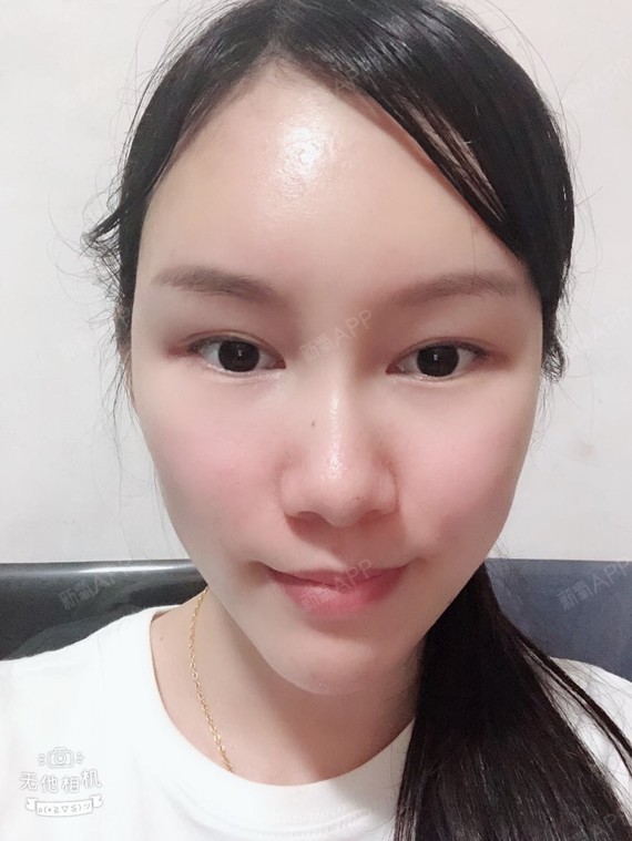 自体脂肪填充全脸