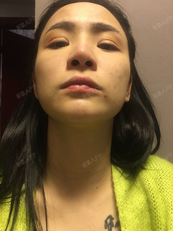 10年前做的最傳統的l型假體鼻子.本來是沒有什麼問_圈子-新氧美容整形