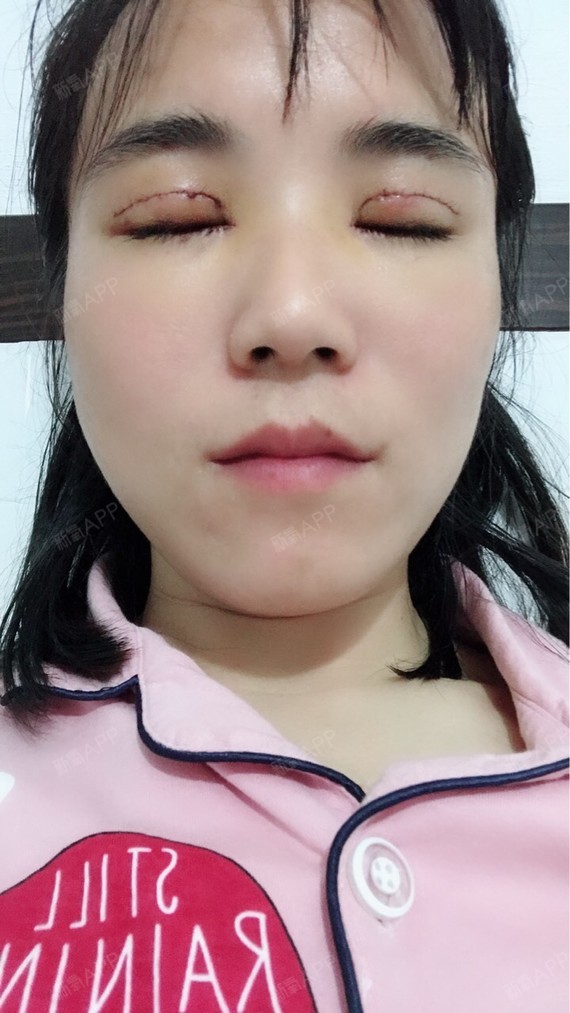 温州开内眼角好不好_效果图_氧气aac44ac开内眼角术后第4天_新氧美容