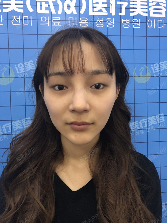 双眼皮宽一点也显得的眼睛深邃一点.