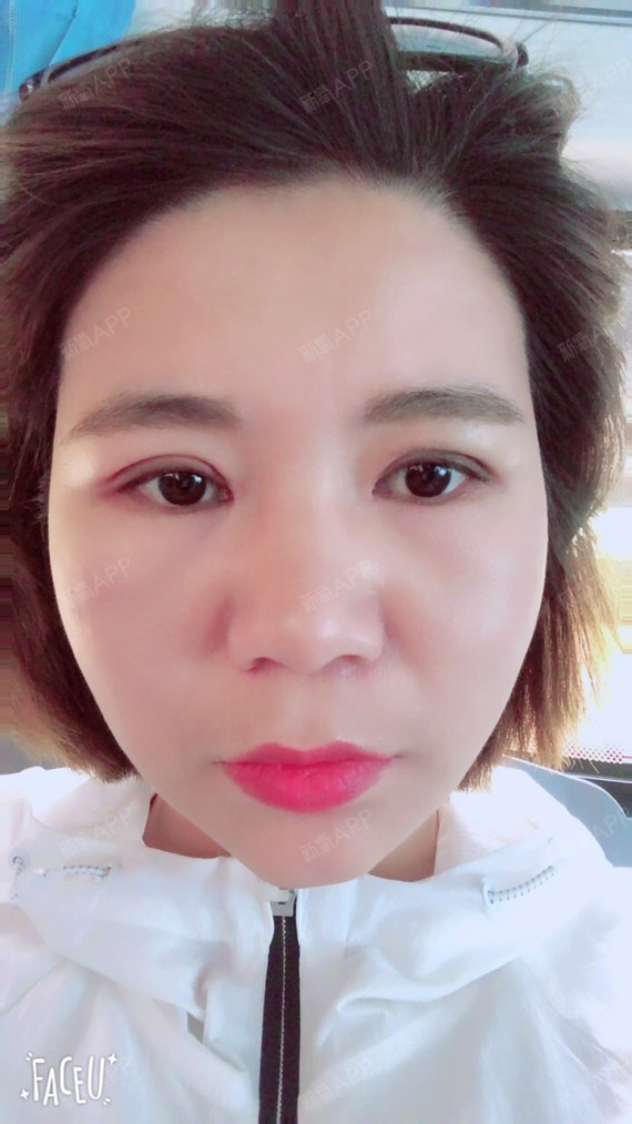 全切双眼皮手术 提眼肌 开前眼角术后15天,面部吸_圈子-新氧美容整形