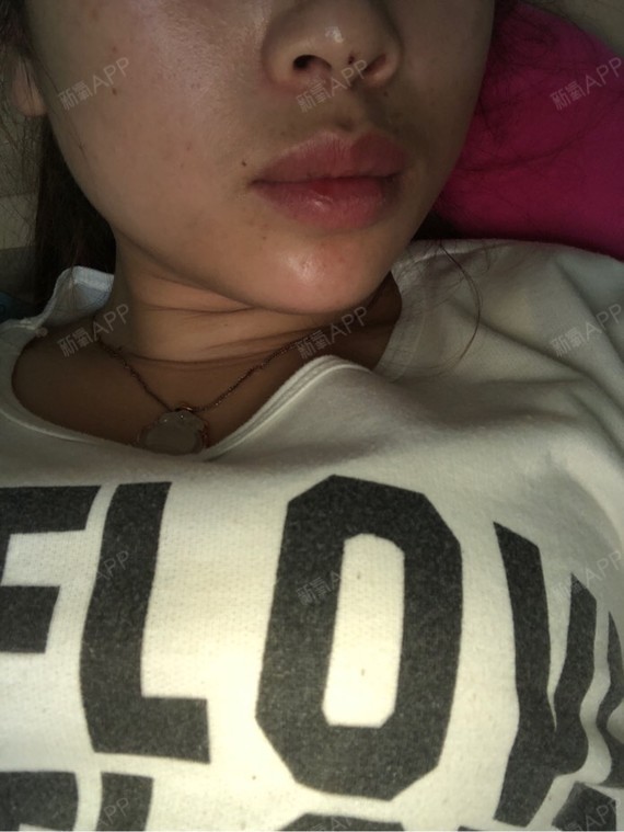 玻尿酸下巴填充术后第一天,有点肿,轻微疼痛,其他没有什么不适