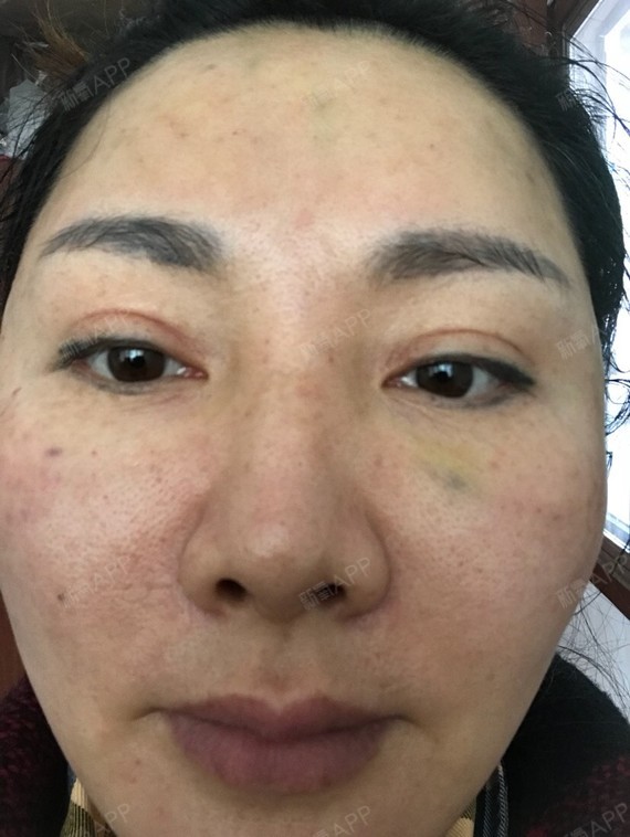 今天9号水光补水后48小时的皮肤状况,针眼还是红色很明显,脸上