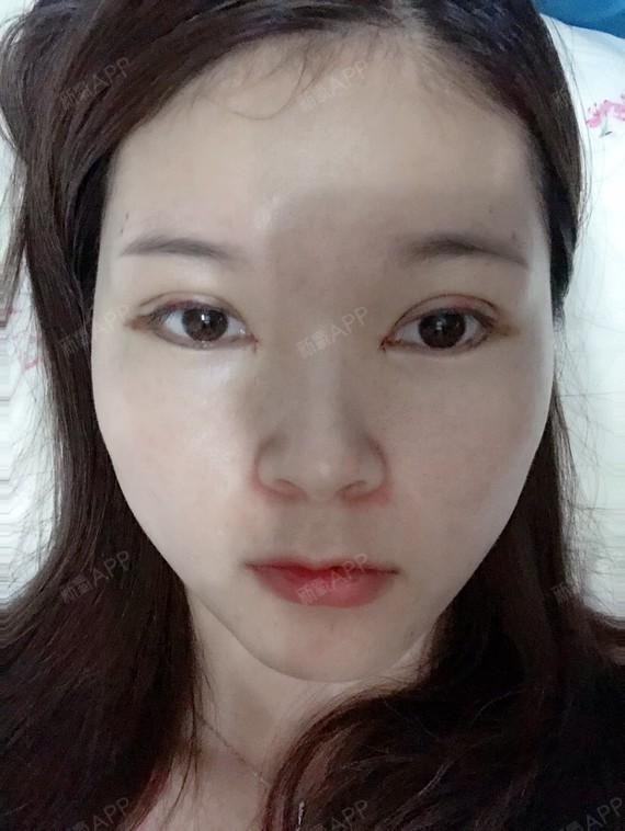 还是眉骨周围肉有点肿,看着眼睛都有点凹进去了,然后显的眼皮变的很窄