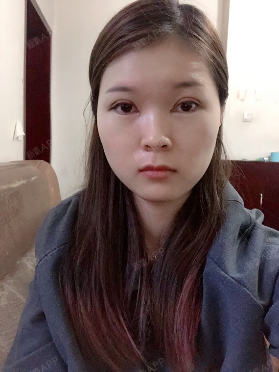 还是眉骨周围肉有点肿,看着眼睛都有点凹进去了,然后显的眼皮变的很窄