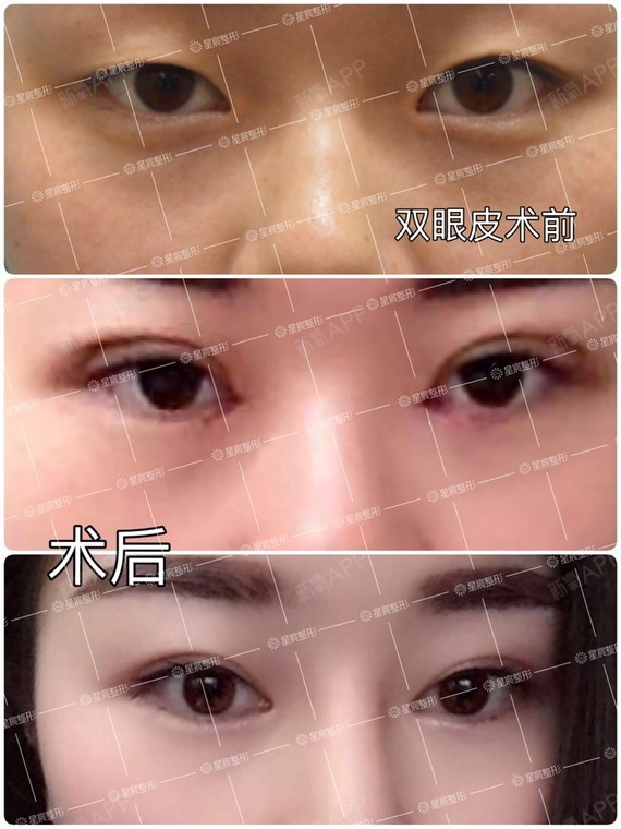 双眼皮手术又名重睑术,亦称双眼皮成形术,是整形美容外科最常见的手术