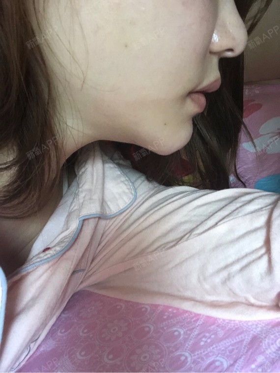 下巴膨体假体取出好不好_效果图_杭州迪丽冷吧下巴膨体假体取出术后第