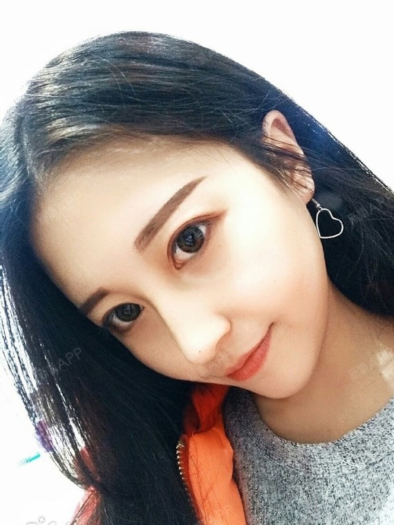 一直想要一个更直挺的下巴,咨询过很多朋友的意见,假_圈子-新氧美容