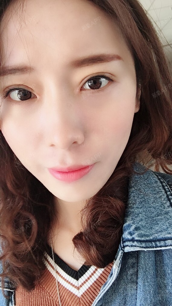 新氧- 氧气6844141520823390 | 眼部 | 开眼角 | 双眼皮 | 开内眼角