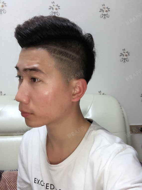 通过新氧消费方案查看玻尿酸垫下巴注射轻度疼痛垫下巴机构查看南昌