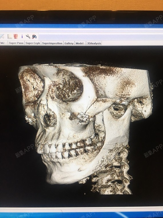 颧骨颧弓整形术好不好_效果图_smallerchin颧骨颧弓整形术术后第4天