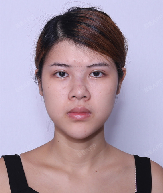 我主要的缺陷是山根低鼻头圆其实我之前的鼻子还没有这么难看因为工作