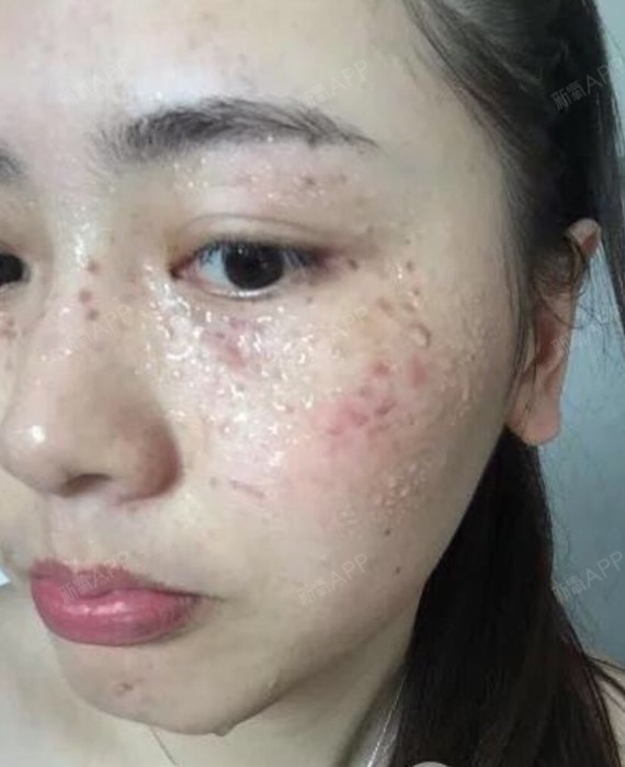 新氧- 氧气5108901523453957 | 激光美肤 | 皮肤 | 术后当自强 | 上海