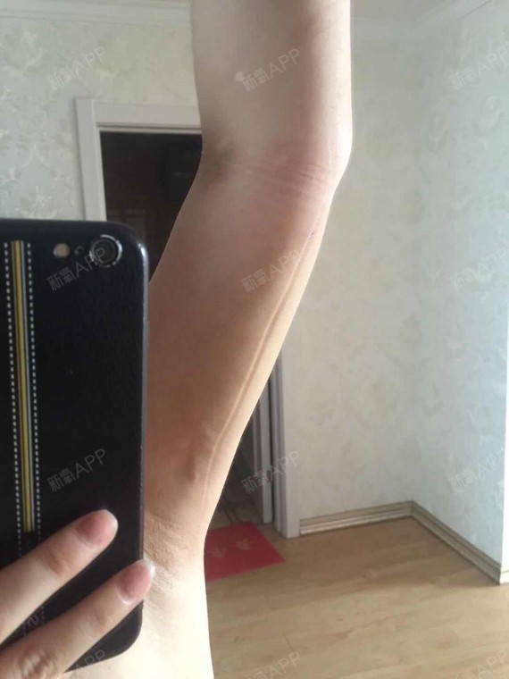 之前去健身房左上臂32.5右上臂32.吸完脂并没有_圈子-新氧美容整形
