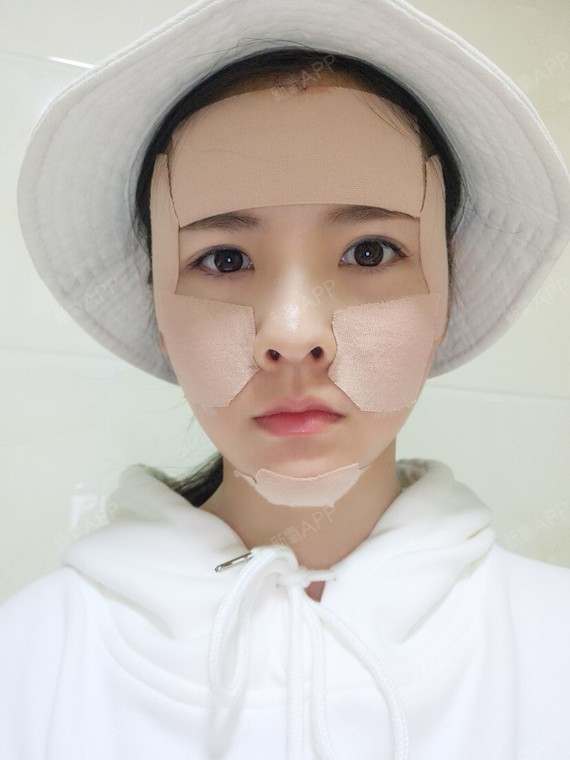 车甜甜自体脂肪丰面颊第3天美丽日记-新氧美容整形