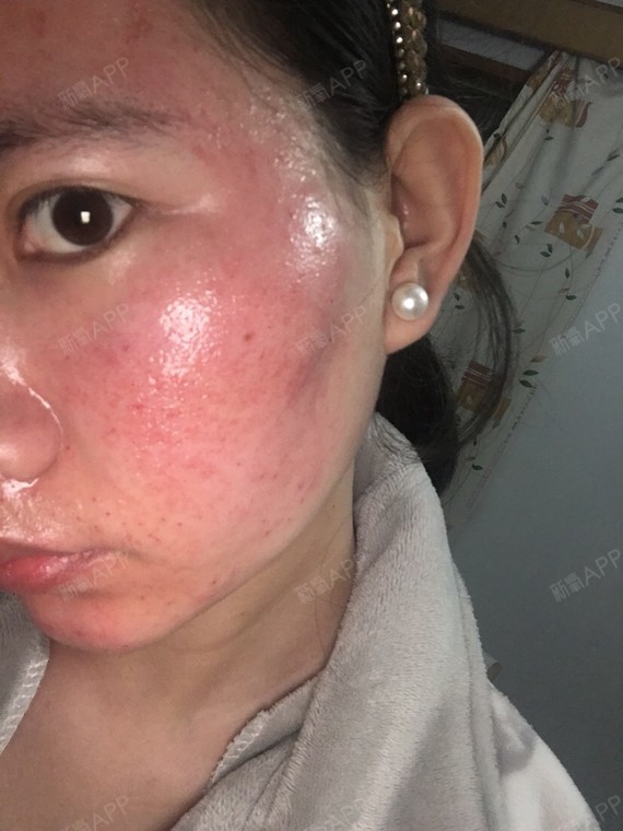 我是做了水光针之后上的微针,可以说是血肉模糊,哈哈.