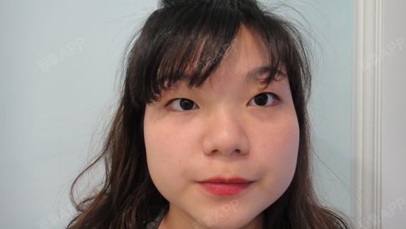 后5天其实有点金鱼眼样子,各位宝宝看了我的术前应_圈子-新氧美容整形