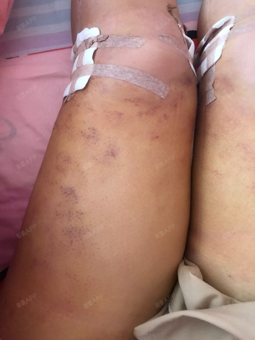 臀部和大腿链接的地方抽太多脂肪了,导致凹陷了,还有_圈子-新氧美容