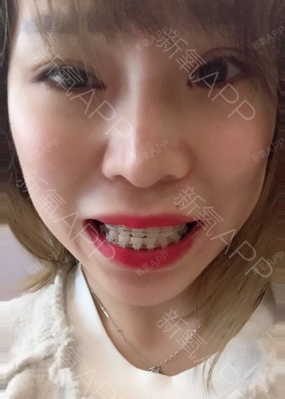 隐形托槽矫正好不好_效果图_翠翠cc隐形托槽矫正术后第75天_新氧美容