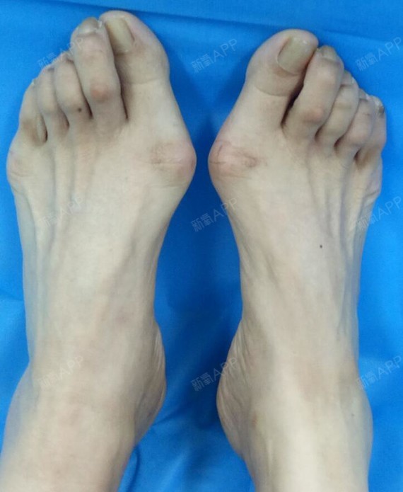 因为大脚骨的原因,左右两侧的脚趾也被挤压到严重变形_圈子-新氧美容
