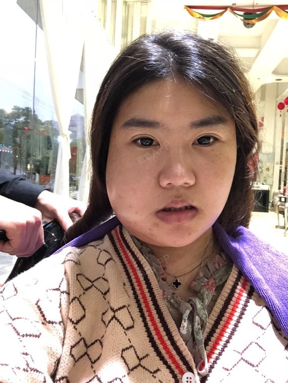 新氧- 懒骨头美少女 | 面部轮廓 | 颧骨颧弓 | 颧骨降低 | v-line