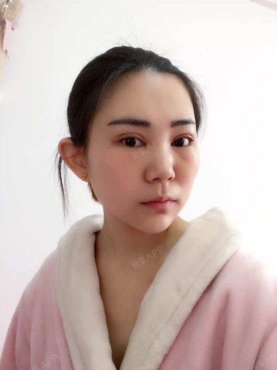 切开双眼皮